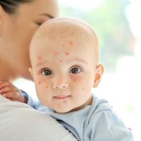 Comment soigner la varicelle ?